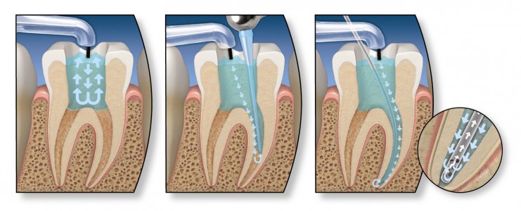 endodoncia2